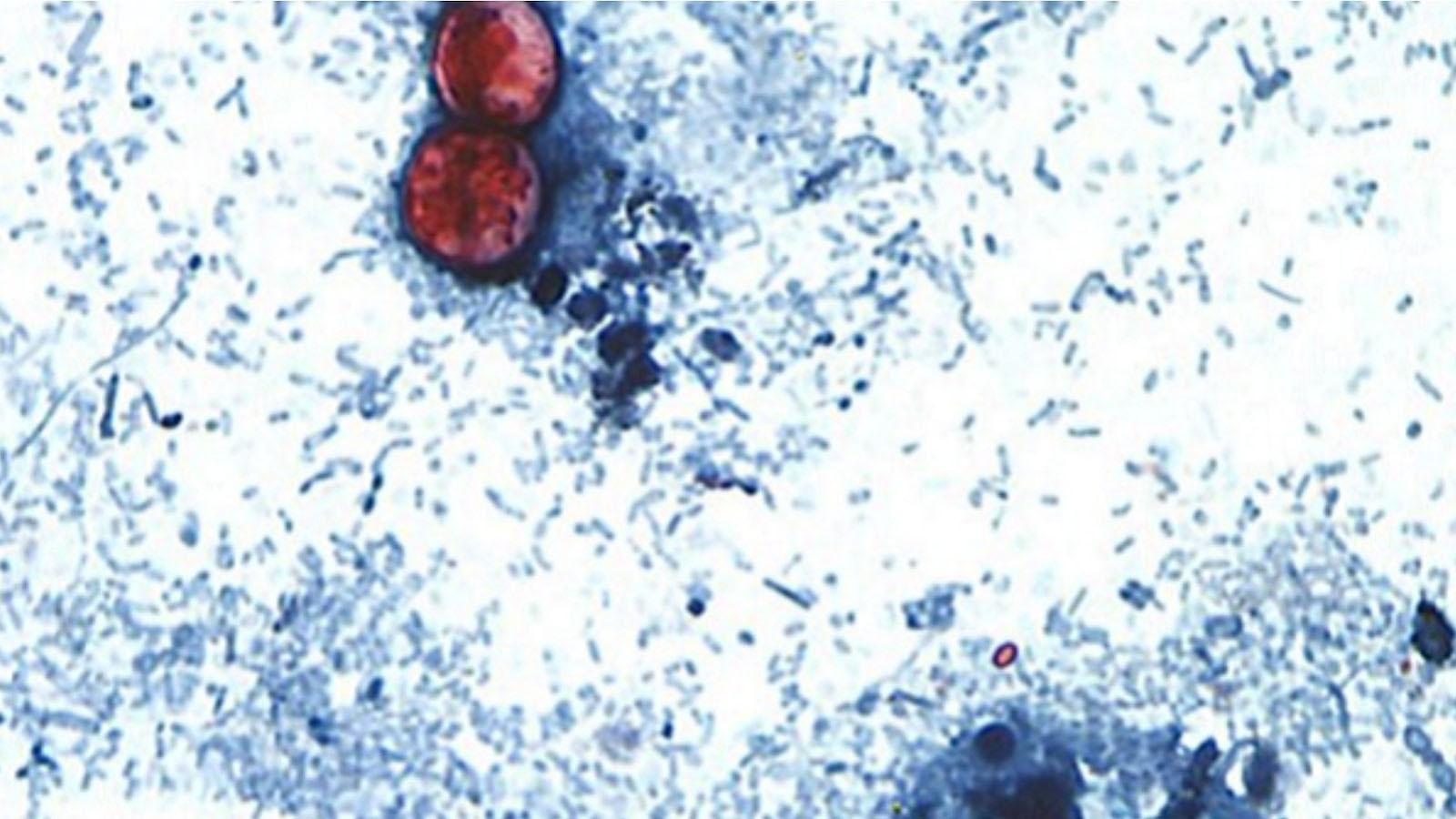 More than 18,000 cyclosporiasis cases reported across 45 states: CDC